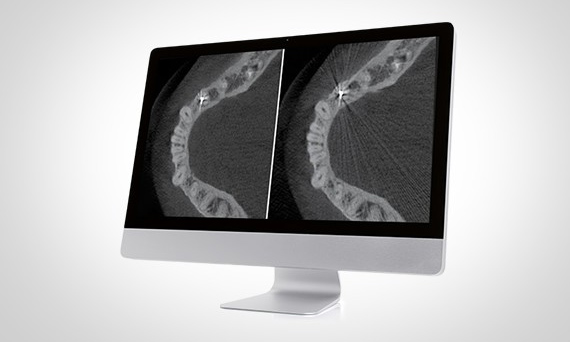 Con el software de reconstrucción MARS, la visualización de los artefactos metálicos se reduce tanto en las visiones de campo próximo como de campo alejado.